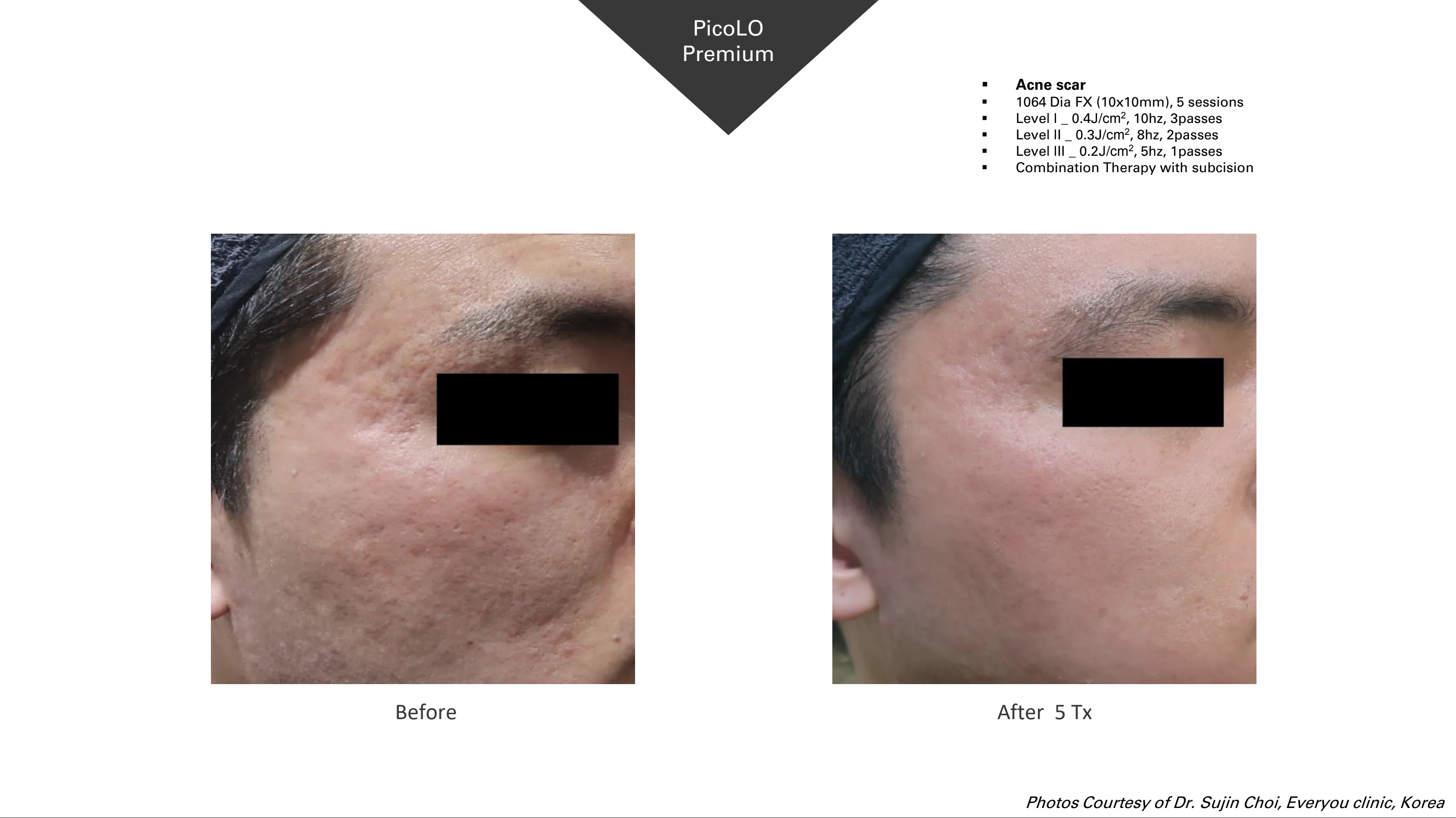 PicoLO Premium before and after example