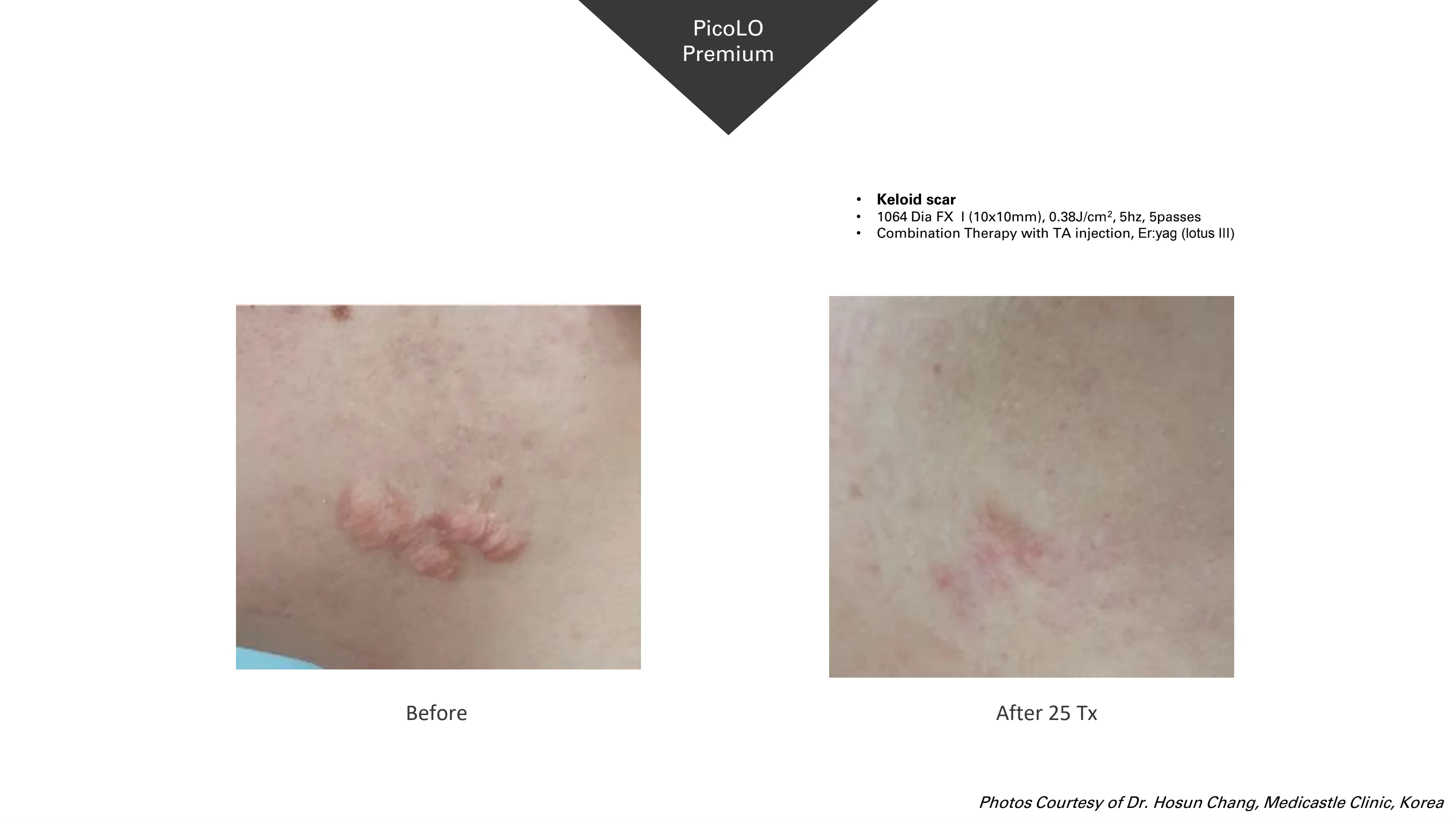 PicoLO Premium before and after example